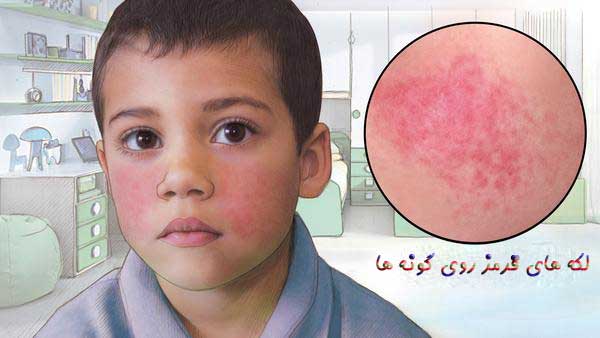 بیماری گونه سیلی خورده - مرکز تصویربرداری نماطب