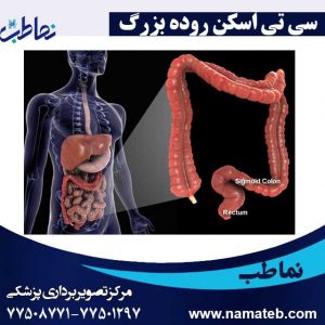 سی-تی-اسکن-روده-بزرگ
