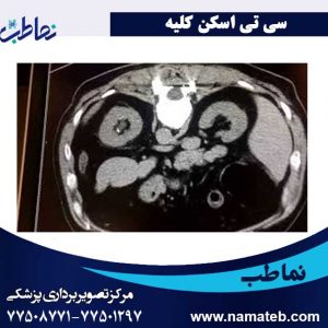 سی-تی-اسکن-کلیه