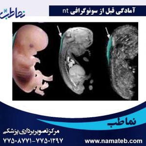 سونوگرافی-nt