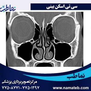 سی-تی-اسکن-بینی