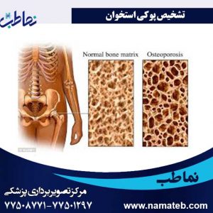 تشخیص-پوکی-استخوان